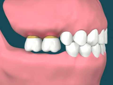 Dental Video of Overeruption Upper Jaw